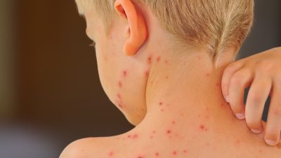 Alla barn ska få gratis vattkoppsvaccin